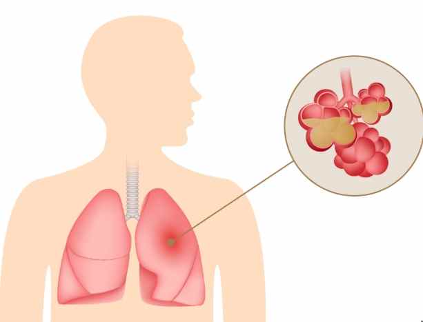 肺炎中藥完全指南：實用治療方案與預防技巧