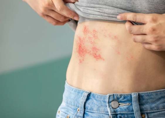 帶狀皰疹中藥治療