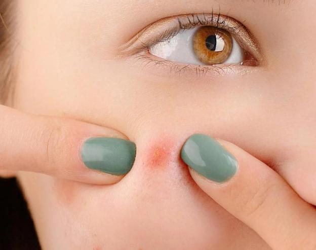 中藥副作用痘痘 中藥副作用痘痘