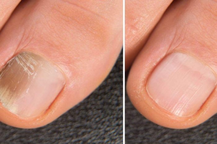 灰指甲治療 灰指甲治療