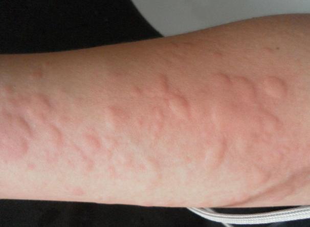 蕁麻疹中藥惡化