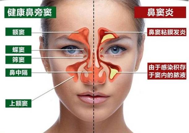 慢性鼻竇炎症狀