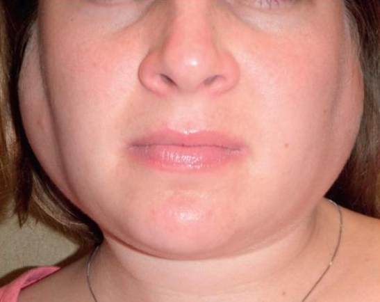 扁桃腺腮腺炎症狀