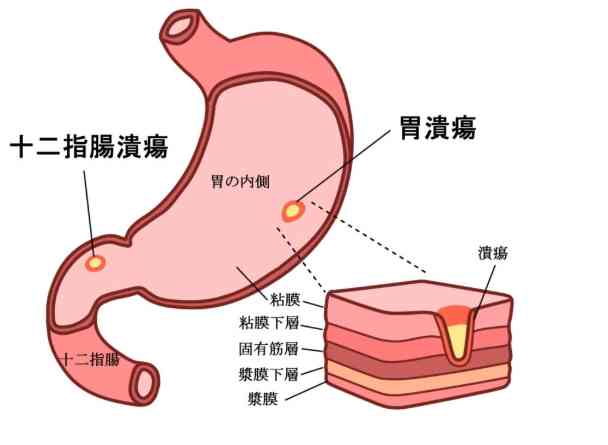 十二指腸潰瘍治療時間