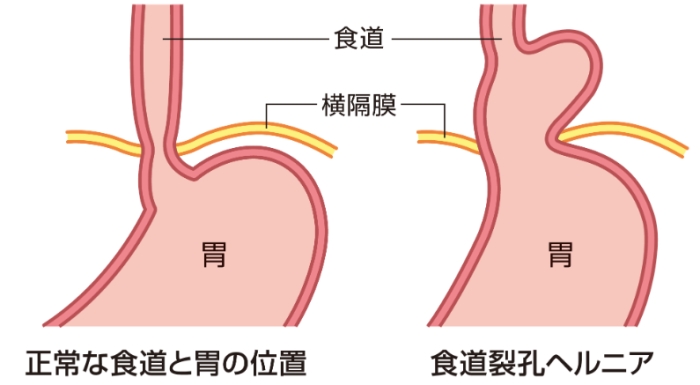 中醫治療胃食道逆流
