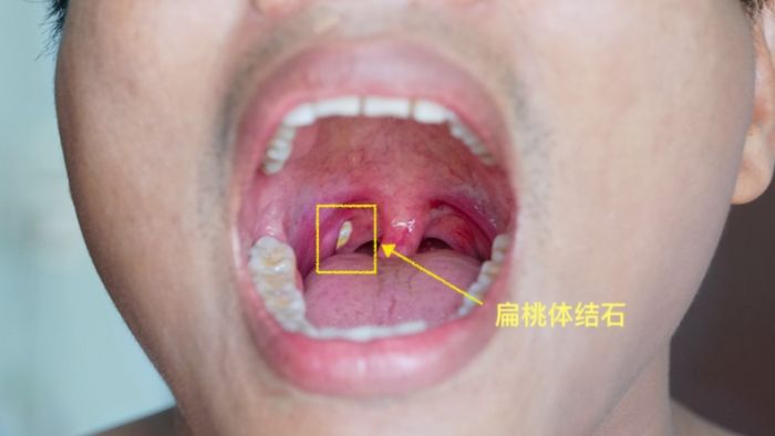 喉嚨破洞癒合時間