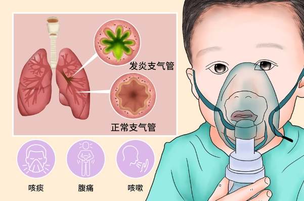 慢性支氣管炎症狀