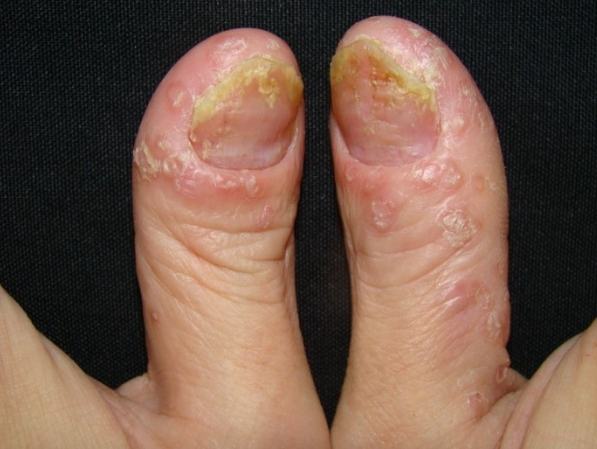 指甲乾癬症狀