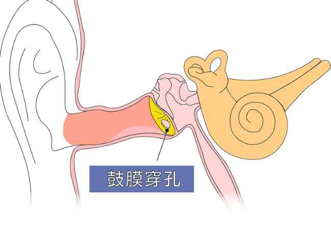 大人中耳炎症狀