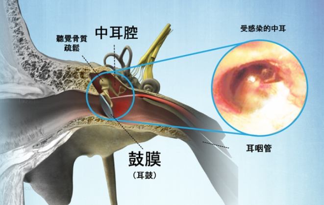 中耳炎恢復時間