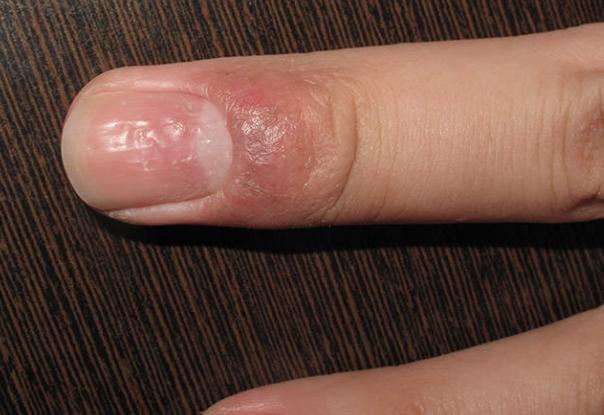汗皰疹手指症狀