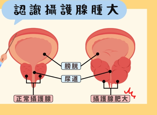 攝護腺手術風險