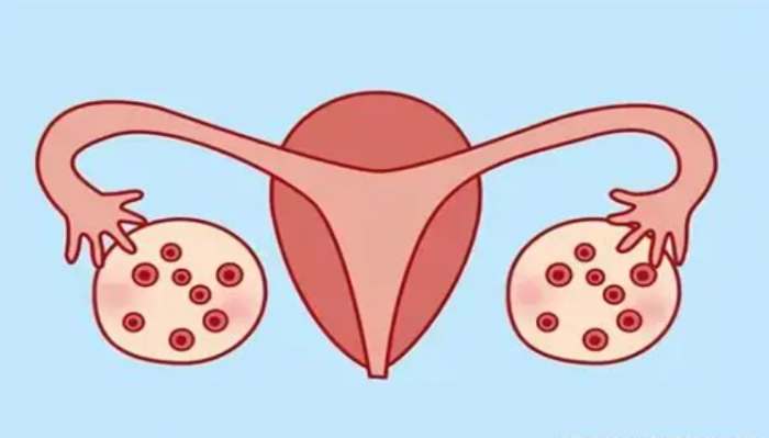 多囊性卵巢治療