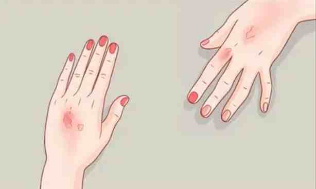 系統性硬皮症診斷