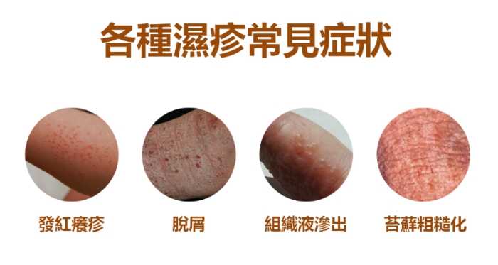 濕疹中醫治療