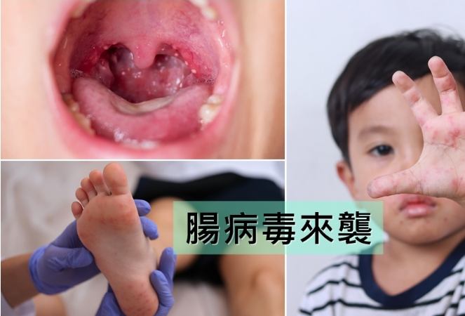 腸病毒口腔潰瘍 腸病毒口腔潰瘍