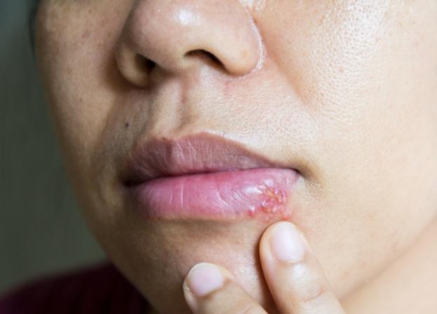 唇皰疹愈合時間