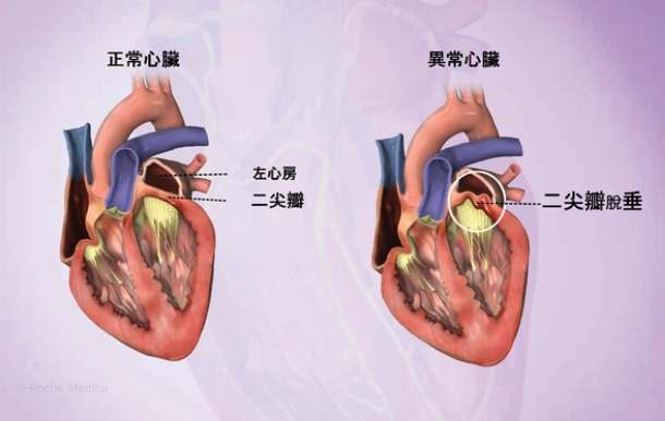二尖瓣脫垂症狀