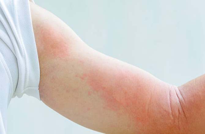 中藥治療蕁麻疹