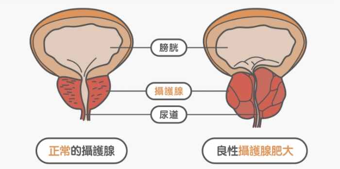 攝護腺肥大藥物副作用