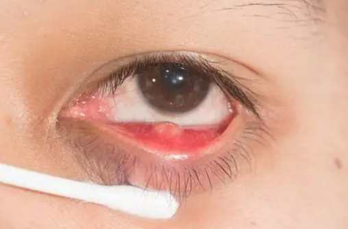 霰粒腫恢復時間