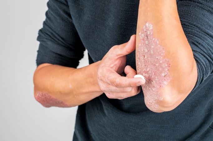 中醫牛皮癬療法