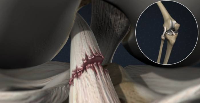 韌帶撕裂恢復時間