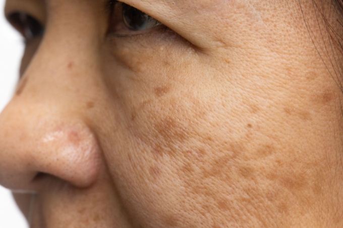 中醫治療荷爾蒙斑