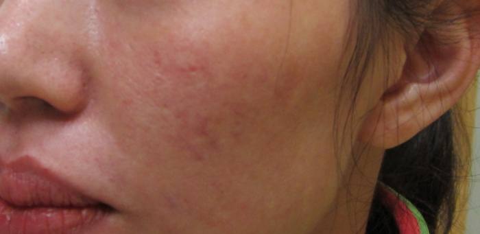 脂漏性皮膚炎治療