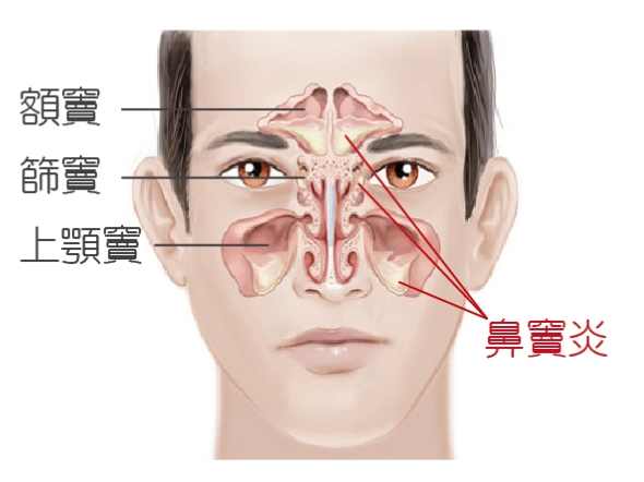 鼻竇炎恢復時間