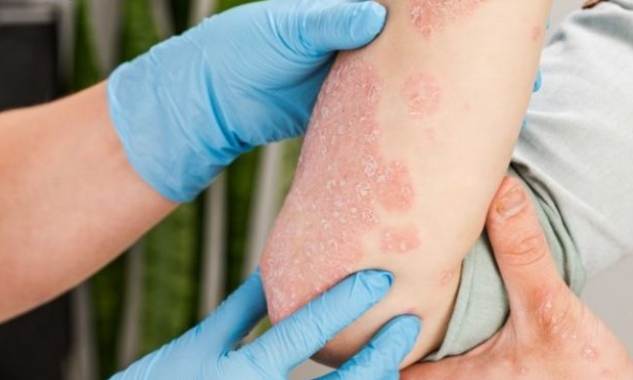 乾癬成因 乾癬成因