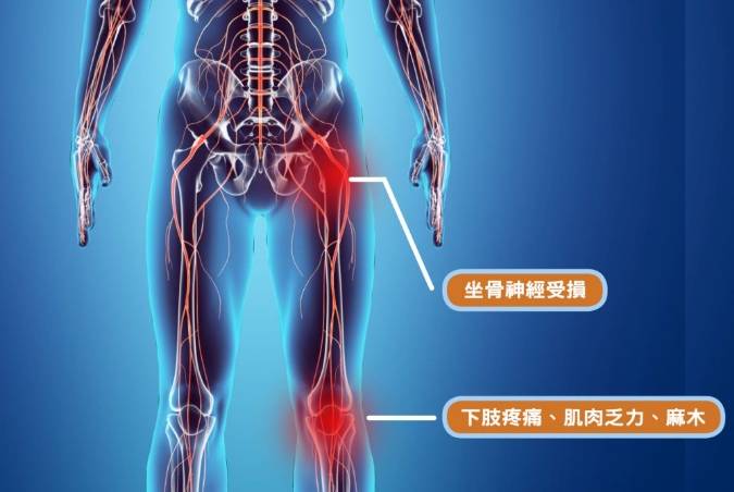 坐骨神經痛康復時間
