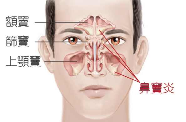 慢性鼻竇炎治療