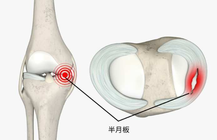 半月板受傷恢復時間