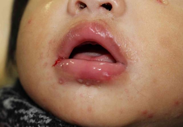 幼兒口腔潰瘍發燒