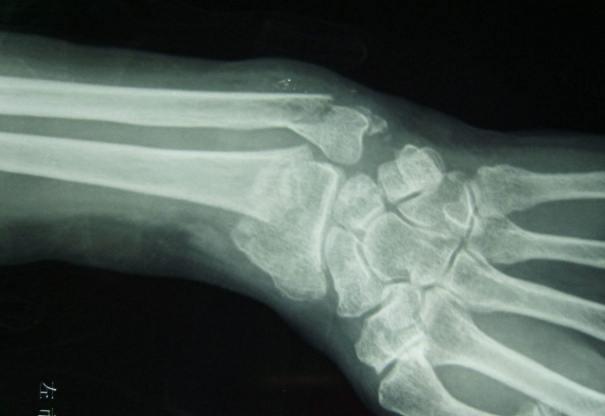 粉碎性骨折恢復時間