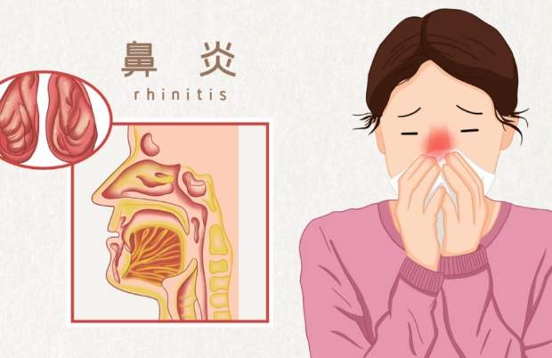 中藥治療過敏性鼻炎