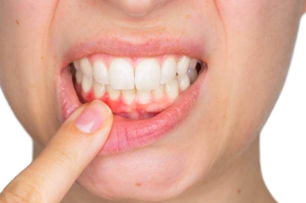 中藥治療牙齦炎 中藥治療牙齦炎