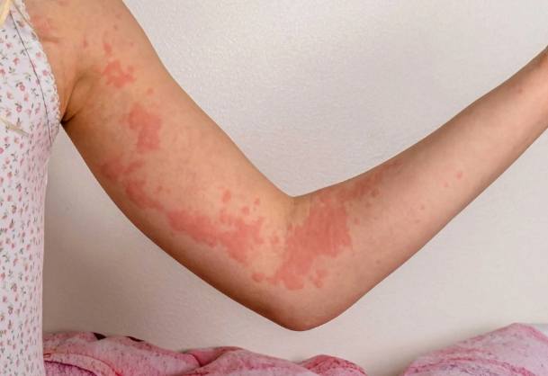 皮膚過敏中藥方劑 皮膚過敏中藥方劑