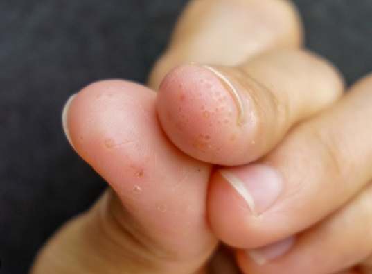 汗皰疹中醫治療