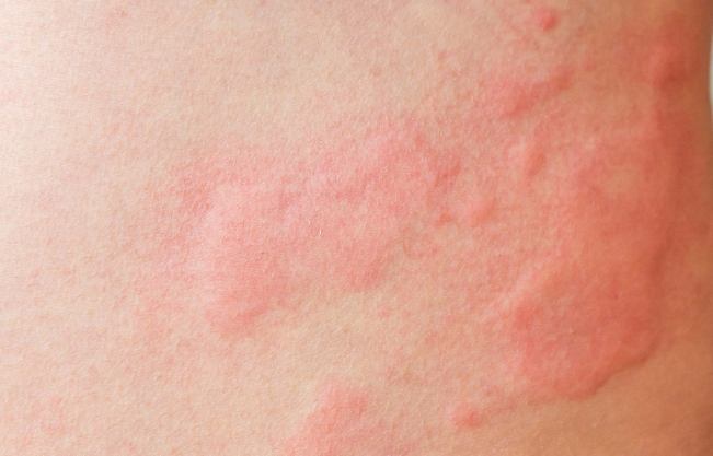 蕁麻疹中醫治療