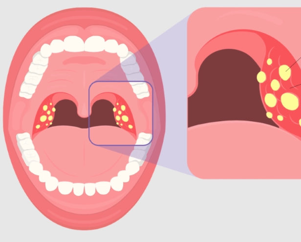 扁桃腺發炎飲食