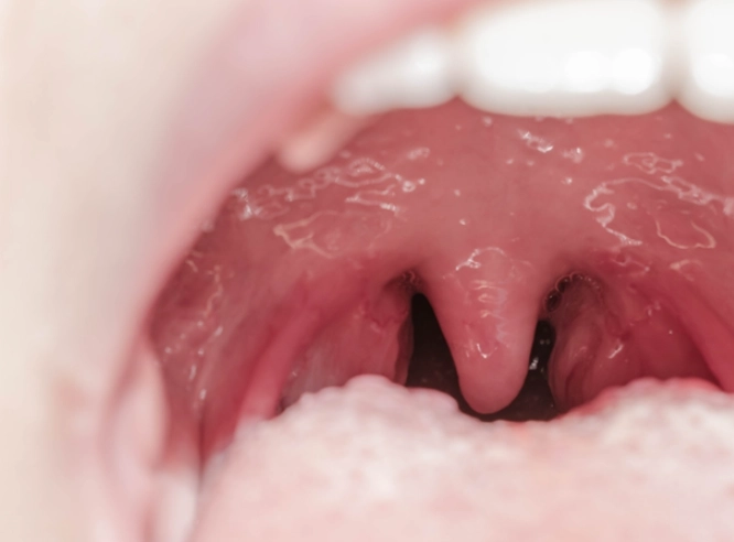 扁桃腺發炎症狀