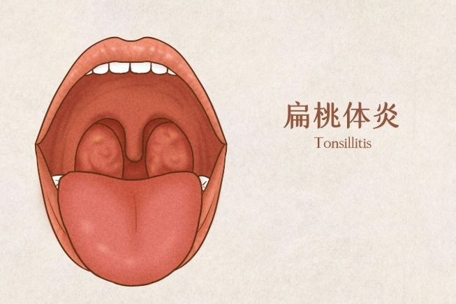 扁桃腺發炎不能吃什麼