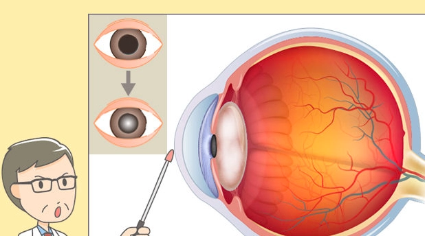 中藥治療白內障