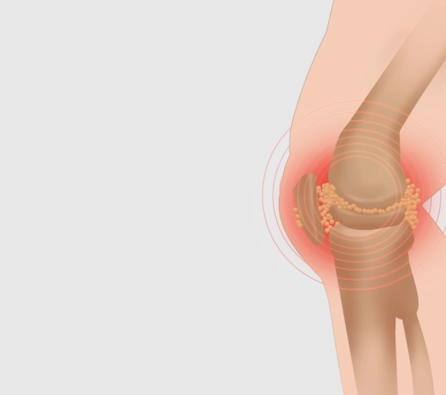 膝蓋韌帶拉傷恢復時間