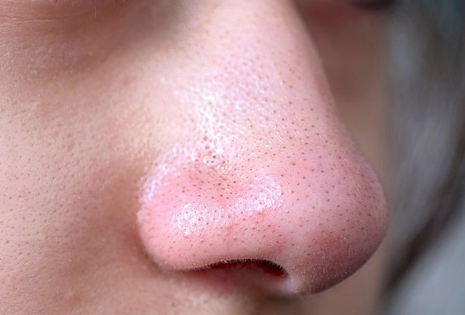 水楊酸副作用粉刺