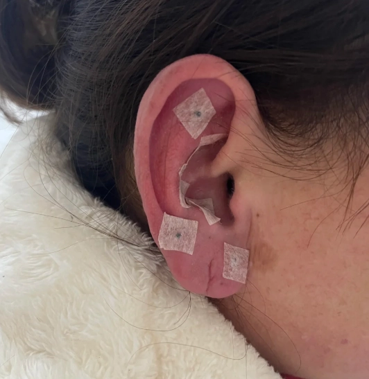 王不留行籽耳穴貼功效