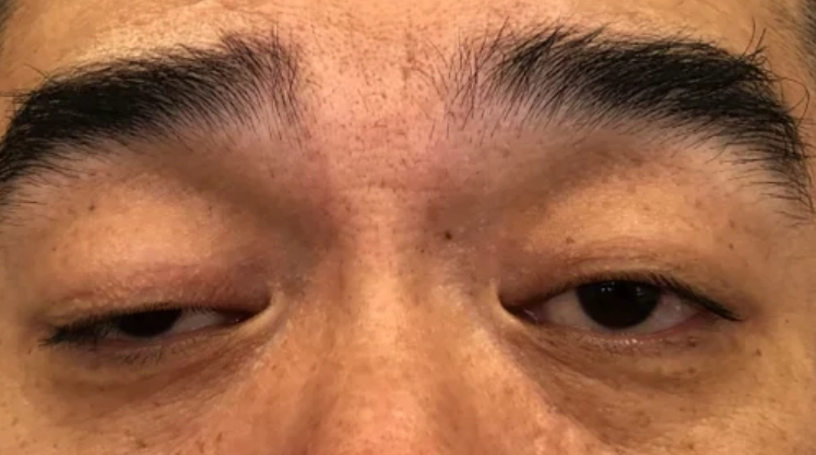 重症肌無力治療