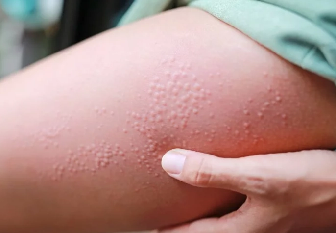 濕疹成因 濕疹成因